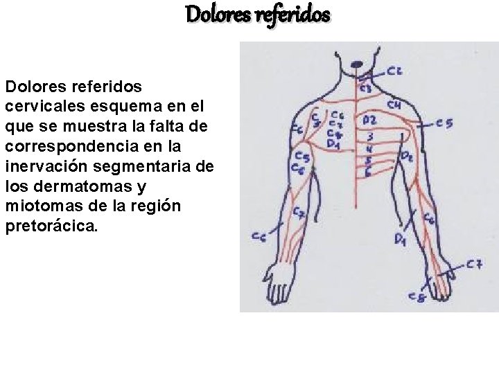 Dolores referidos cervicales esquema en el que se muestra la falta de correspondencia en