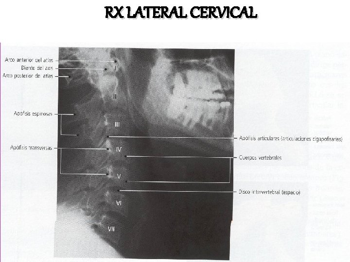 RX LATERAL CERVICAL RX LATERAL CERVICAL