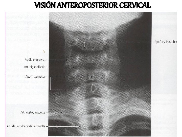 VISIÓN ANTEROPOSTERIOR CERVICAL 