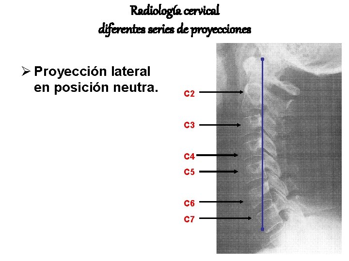 Radiología cervical diferentes series de proyecciones Ø Proyección lateral en posición neutra. C 2 Radiología cervical diferentes series de proyecciones Ø Proyección lateral en posición neutra. C 2