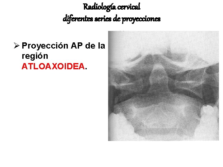 Radiología cervical diferentes series de proyecciones Ø Proyección AP de la región ATLOAXOIDEA. 