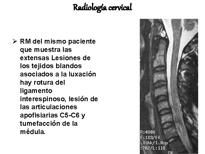 Radiología cervical Ø RM del mismo paciente que muestra las extensas Lesiones de los