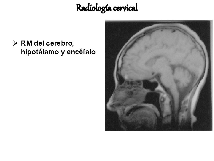 Radiología cervical Ø RM del cerebro, hipotálamo y encéfalo 