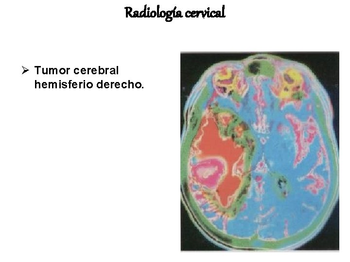 Radiología cervical Ø Tumor cerebral hemisferio derecho. 