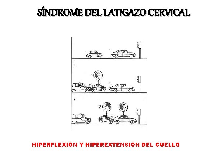 SÍNDROME DEL LATIGAZO CERVICAL HIPERFLEXIÓN Y HIPEREXTENSIÓN DEL CUELLO 