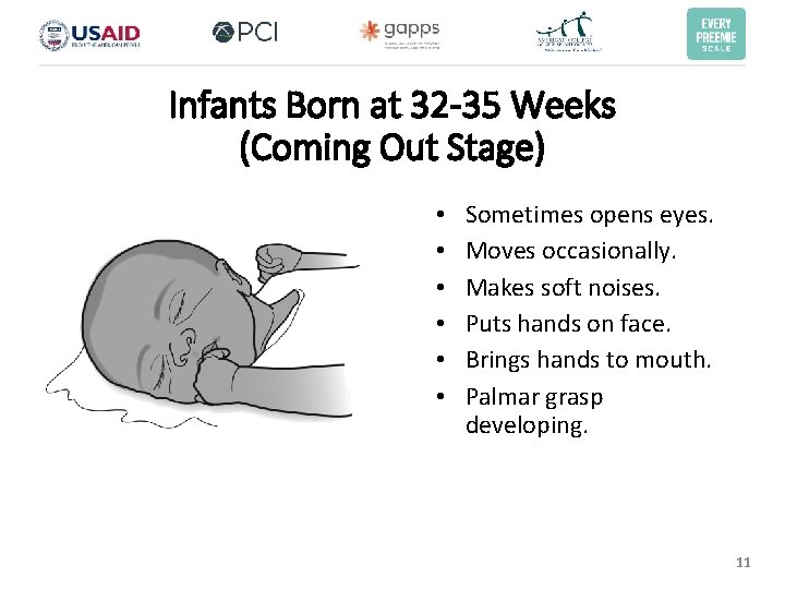 Infants Born at 32 -35 Weeks (Coming Out Stage) • • • Sometimes opens Infants Born at 32 -35 Weeks (Coming Out Stage) • • • Sometimes opens