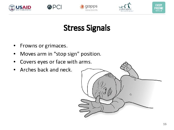 Stress Signals • • Frowns or grimaces. Moves arm in “stop sign” position. Covers Stress Signals • • Frowns or grimaces. Moves arm in “stop sign” position. Covers