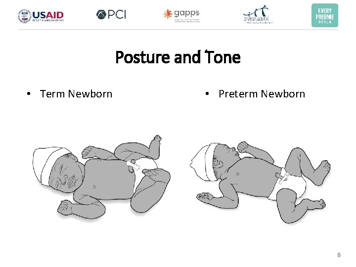 Posture and Tone • Term Newborn • Preterm Newborn 6 Posture and Tone • Term Newborn • Preterm Newborn 6