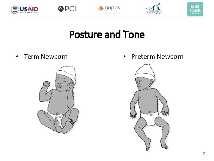Posture and Tone • Term Newborn • Preterm Newborn 7 Posture and Tone • Term Newborn • Preterm Newborn 7