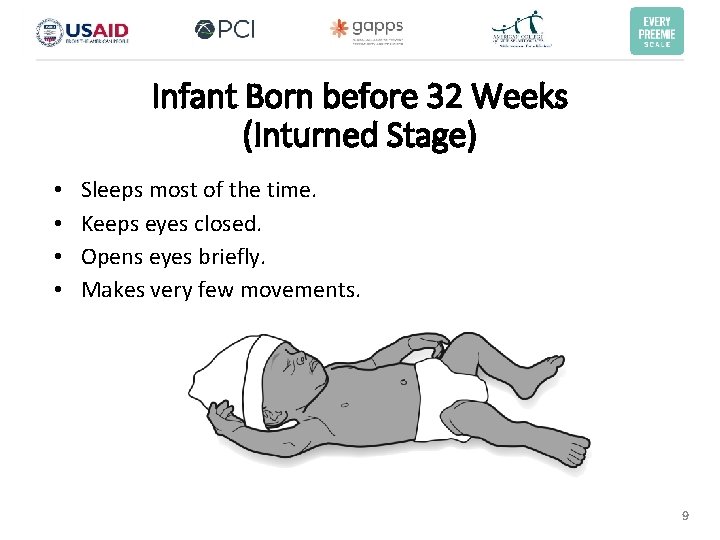 Infant Born before 32 Weeks (Inturned Stage) • • Sleeps most of the time. Infant Born before 32 Weeks (Inturned Stage) • • Sleeps most of the time.