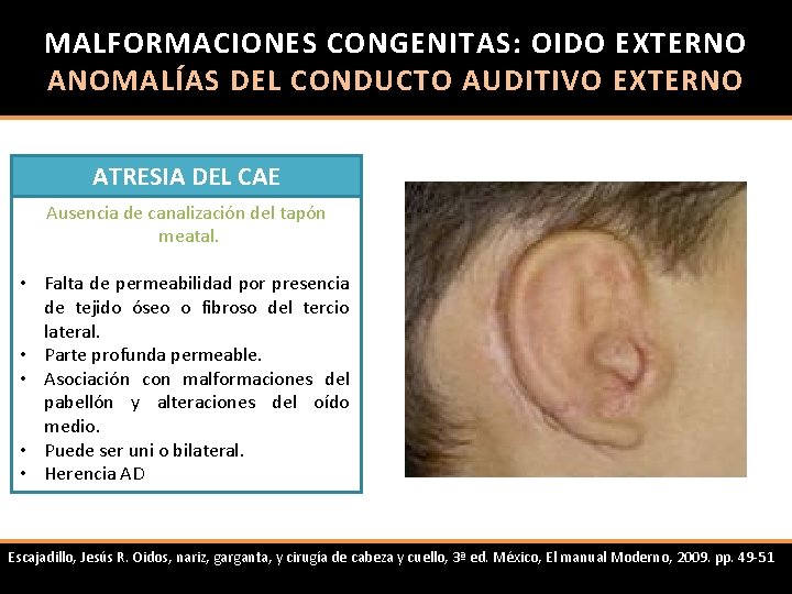 MALFORMACIONES CONGENITAS: OIDO EXTERNO ANOMALÍAS DEL CONDUCTO AUDITIVO EXTERNO ATRESIA DEL CAE Ausencia de