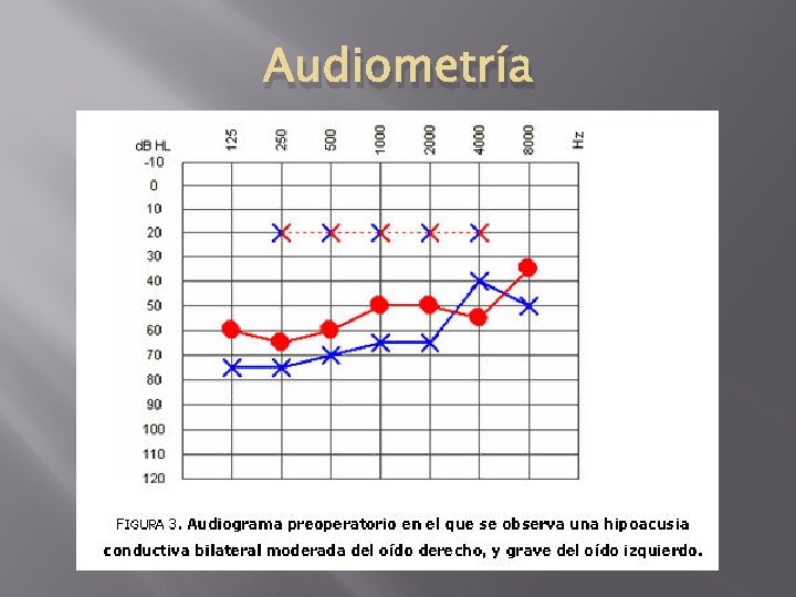 Audiometría 