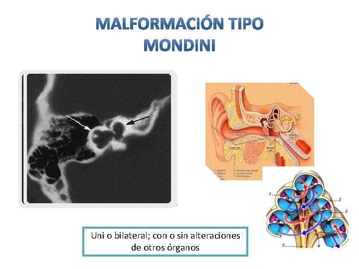  • Aplanamiento de la cápsula ósea coclear Síndrome acompañados de esta • Falta