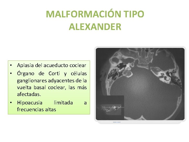 MALFORMACIÓN TIPO ALEXANDER • Aplasia del acueducto coclear • Órgano de Corti y células