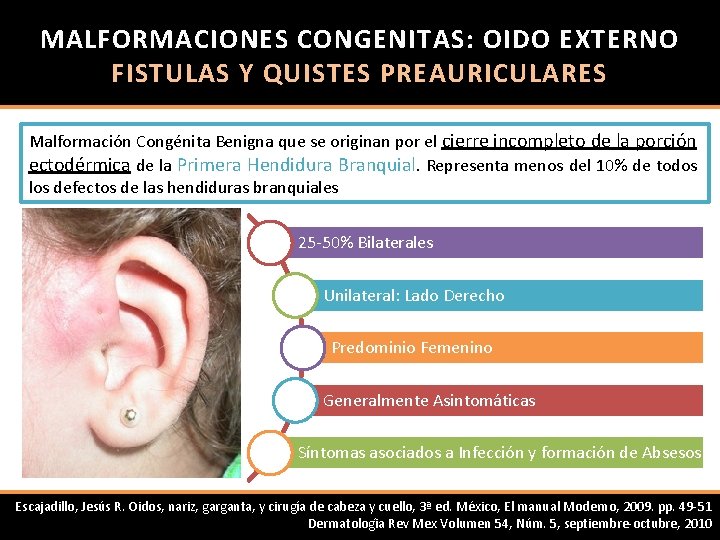 MALFORMACIONES CONGENITAS: OIDO EXTERNO FISTULAS Y QUISTES PREAURICULARES Malformación Congénita Benigna que se originan