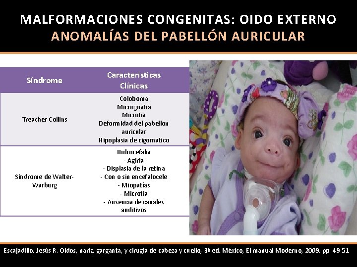 MALFORMACIONES CONGENITAS: OIDO EXTERNO ANOMALÍAS DEL PABELLÓN AURICULAR Síndrome Características Clínicas Treacher Collins Coloboma