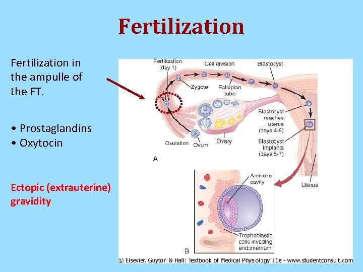 Fertilization in the ampulle of the FT. • Prostaglandins • Oxytocin Ectopic (extrauterine) gravidity Fertilization in the ampulle of the FT. • Prostaglandins • Oxytocin Ectopic (extrauterine) gravidity