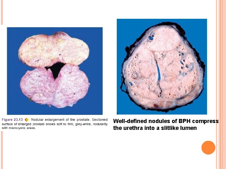 Well-defined nodules of BPH compress the urethra into a slitlike lumen 