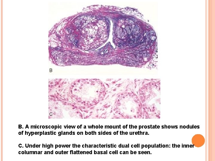 B. A microscopic view of a whole mount of the prostate shows nodules of