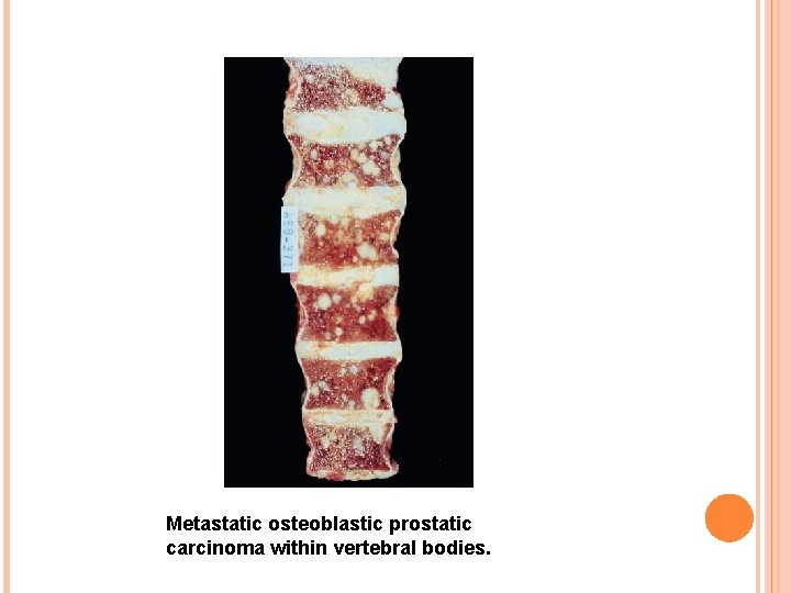 Metastatic osteoblastic prostatic carcinoma within vertebral bodies. 