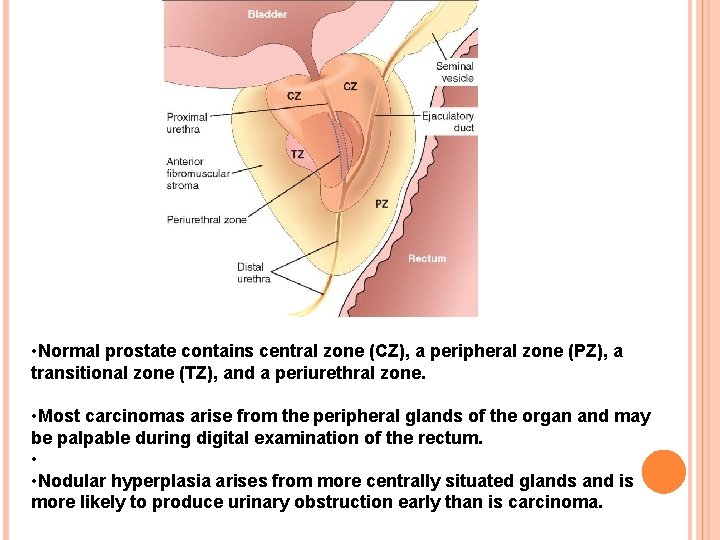  • Normal prostate contains central zone (CZ), a peripheral zone (PZ), a transitional