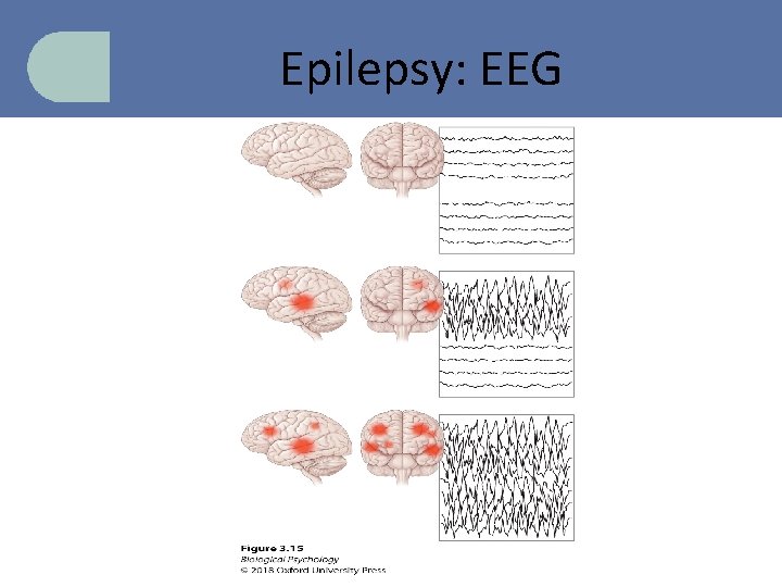 Epilepsy: EEG 