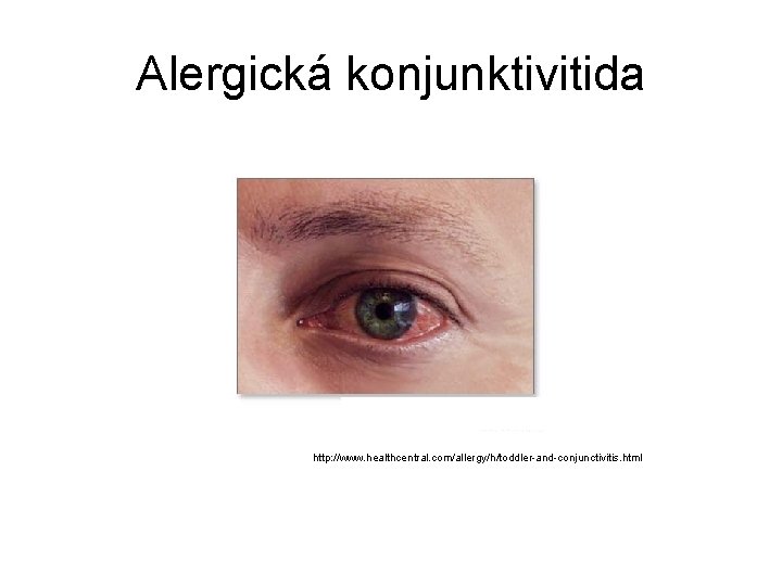 Alergická konjunktivitida http: //www. healthcentral. com/allergy/h/toddler-and-conjunctivitis. html 