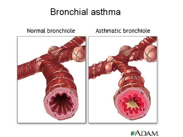Bronchial asthma Bronchial asthma