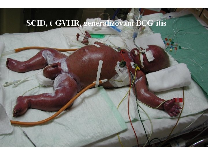 SCID, t-GVHR, generalizovaní BCG-itis SCID, t-GVHR, generalizovaní BCG-itis