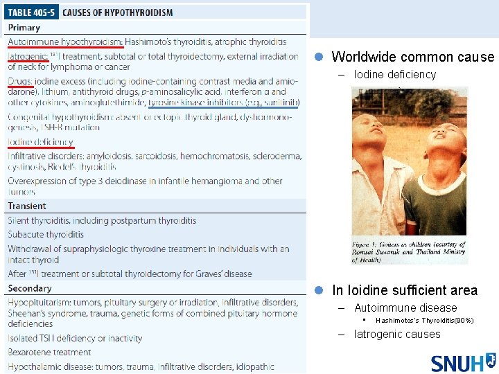 l Worldwide common cause – Iodine deficiency l In Ioidine sufficient area – Autoimmune l Worldwide common cause – Iodine deficiency l In Ioidine sufficient area – Autoimmune