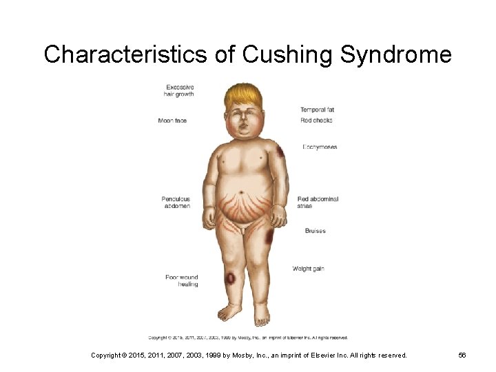 Characteristics of Cushing Syndrome Copyright © 2015, 2011, 2007, 2003, 1999 by Mosby, Inc.