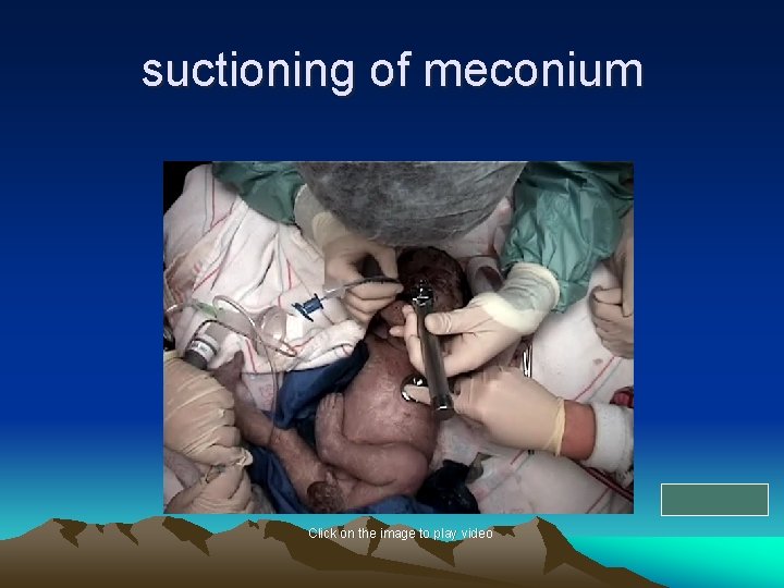 suctioning of meconium Click on the image to play video 