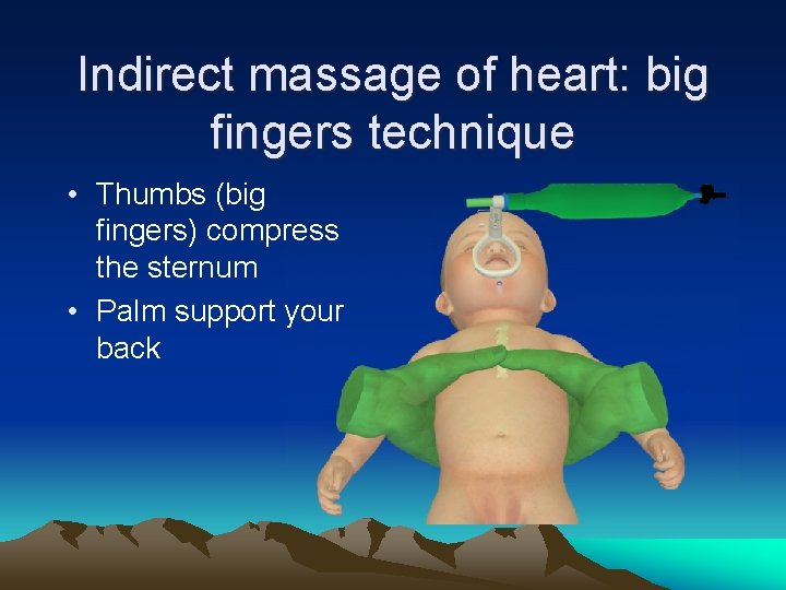 Indirect massage of heart: big fingers technique • Thumbs (big fingers) compress the sternum