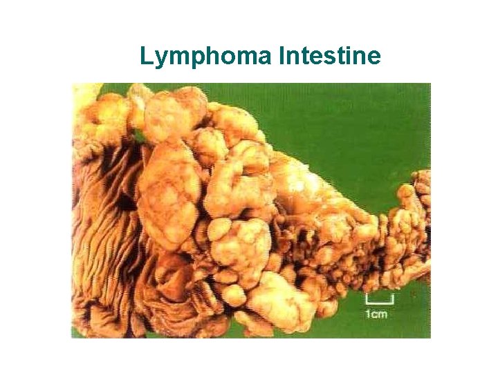 Lymphoma Intestine Lymphoma Intestine