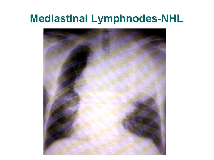 Mediastinal Lymphnodes-NHL Mediastinal Lymphnodes-NHL