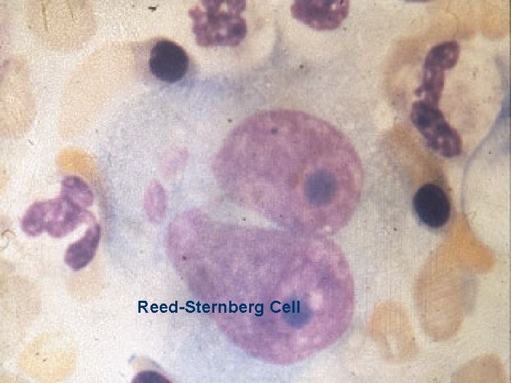 Reed-Sternberg Cell 14 Reed-Sternberg Cell 14