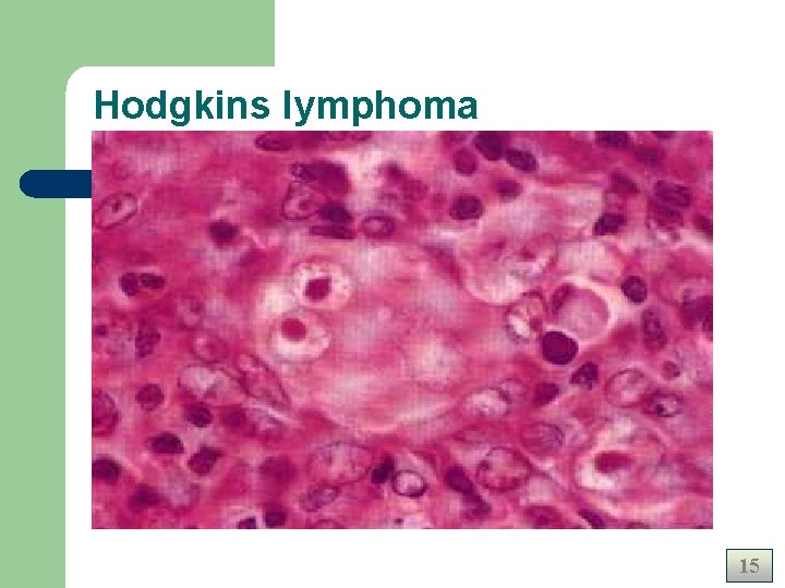 Hodgkins lymphoma 15 Hodgkins lymphoma 15