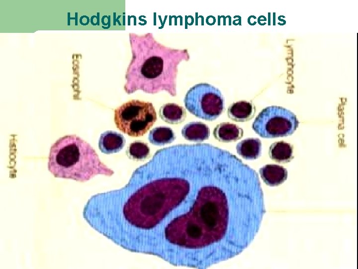 Hodgkins lymphoma cells 16 Hodgkins lymphoma cells 16