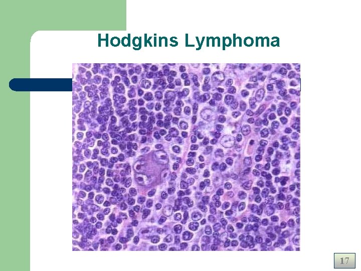 Hodgkins Lymphoma 17 Hodgkins Lymphoma 17