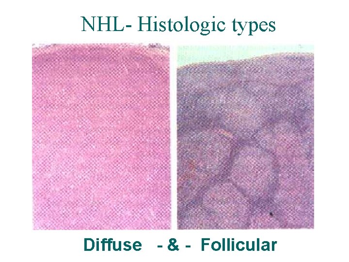 NHL- Histologic types Diffuse - & - Follicular NHL- Histologic types Diffuse - & - Follicular
