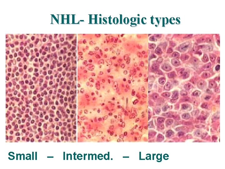NHL- Histologic types Small – Intermed. – Large NHL- Histologic types Small – Intermed. – Large