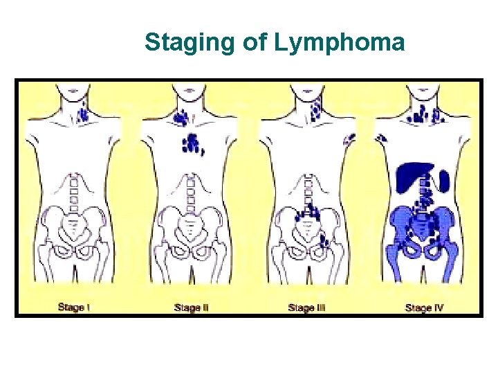 Staging of Lymphoma Staging of Lymphoma