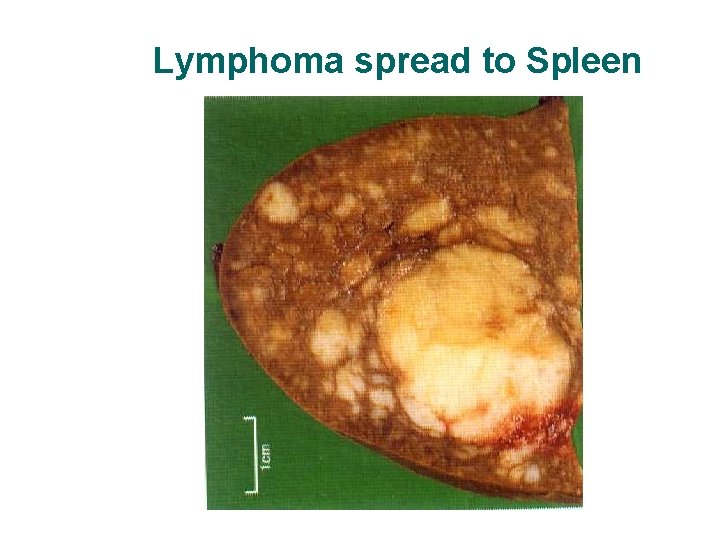 Lymphoma spread to Spleen Lymphoma spread to Spleen