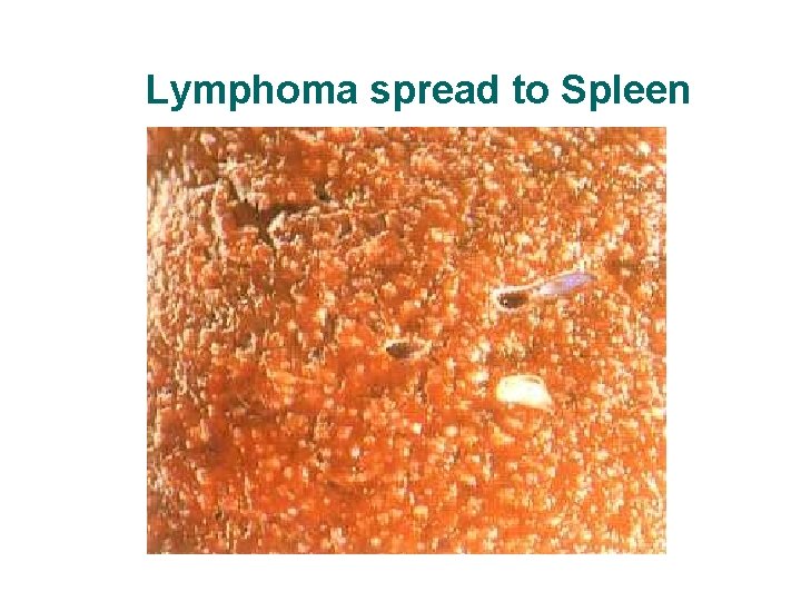 Lymphoma spread to Spleen Lymphoma spread to Spleen
