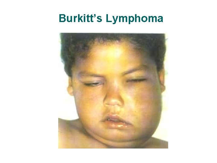Burkitt’s Lymphoma Burkitt’s Lymphoma