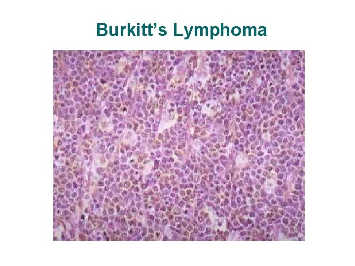 Burkitt’s Lymphoma Burkitt’s Lymphoma