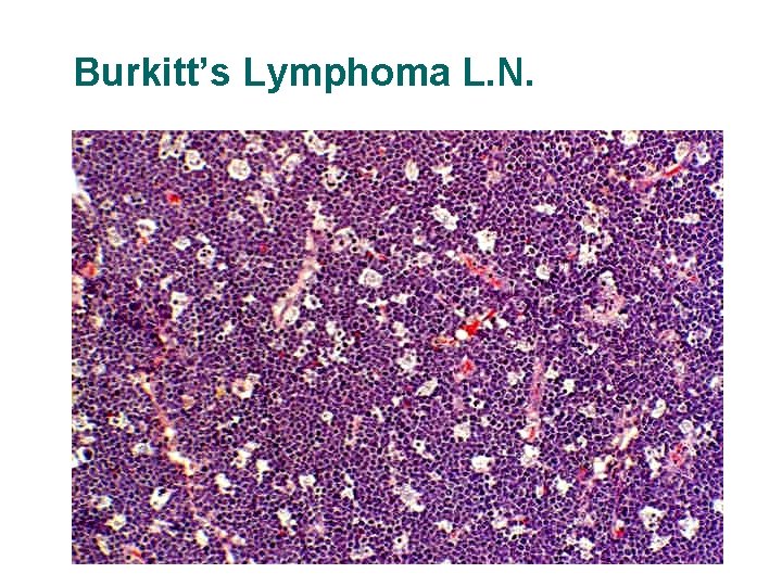 Burkitt’s Lymphoma L. N. Burkitt’s Lymphoma L. N.