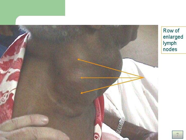 Lymphoma Row of enlarged lymph nodes 7 Lymphoma Row of enlarged lymph nodes 7