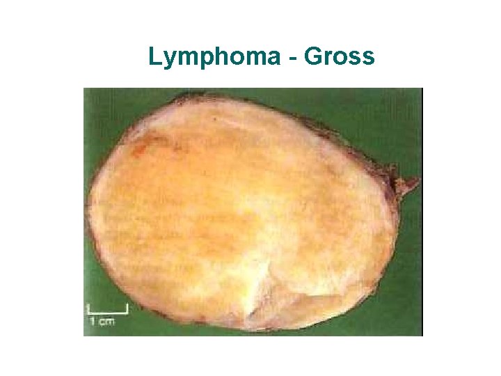 Lymphoma - Gross Lymphoma - Gross