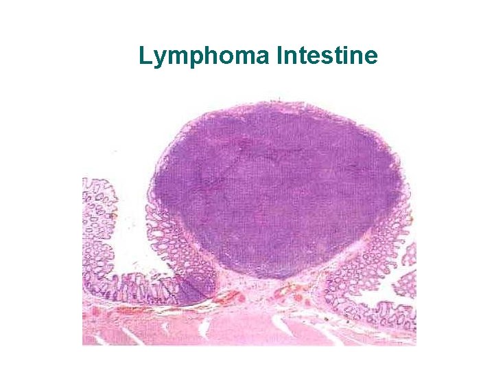 Lymphoma Intestine Lymphoma Intestine